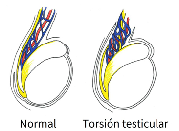 Torsión testicular intravaginal.